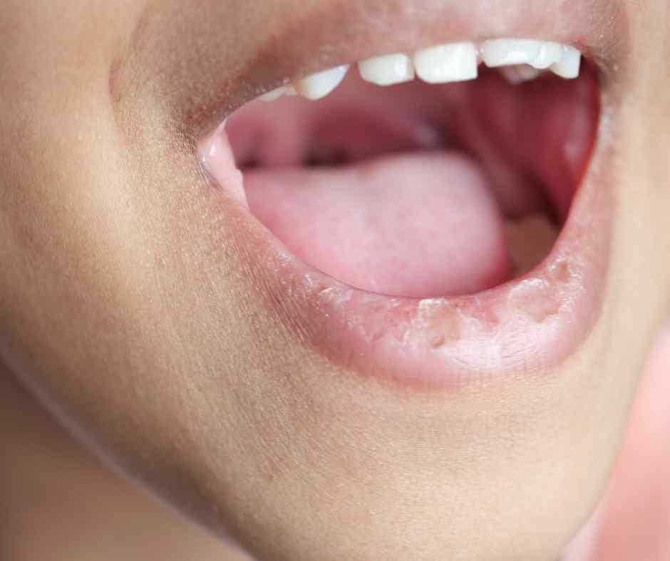 Dry mouth symptoms