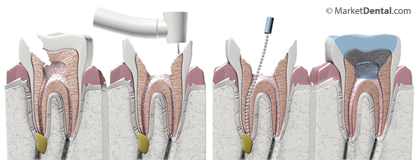 2. A close-up of a tooth extraction procedure, showing the dentist using tools to remove a tooth from a patient's mouth.