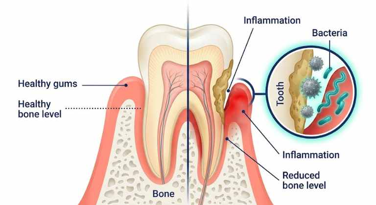 Dental Biofilm and Plaque